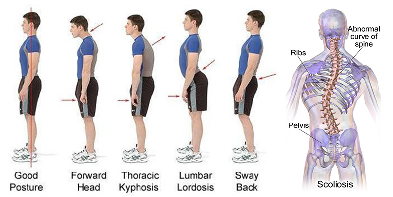 Posture Correction Treatment Mont Kiara - ONI Physio Fitness