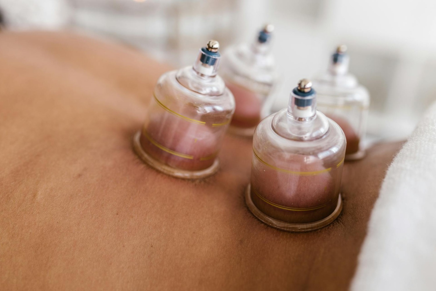 Benefits of cupping therapy