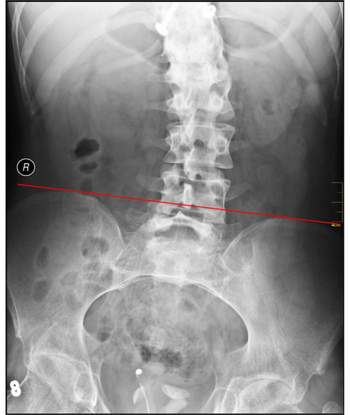 Scoliosis Mont Kiara Kuala Lumpur