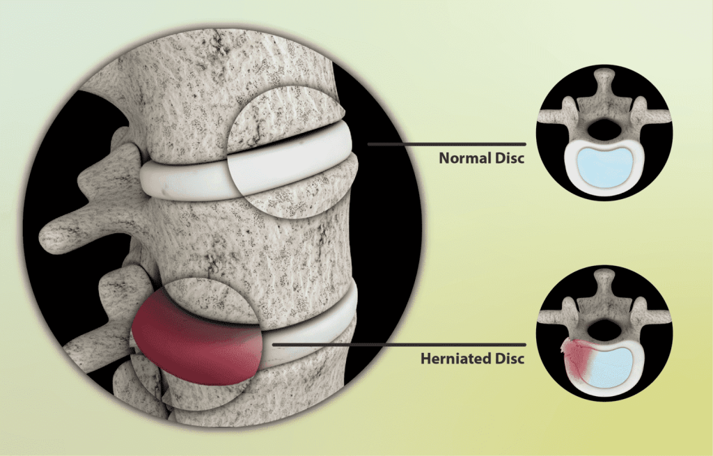 Herniated Disc (Slipped disc) lower back pain