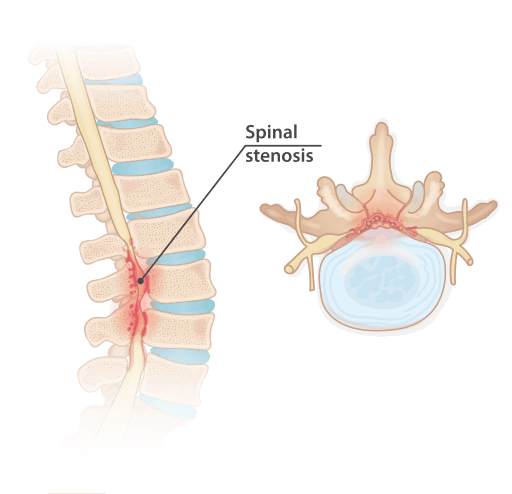 Spinal stenosis kuala lumpur