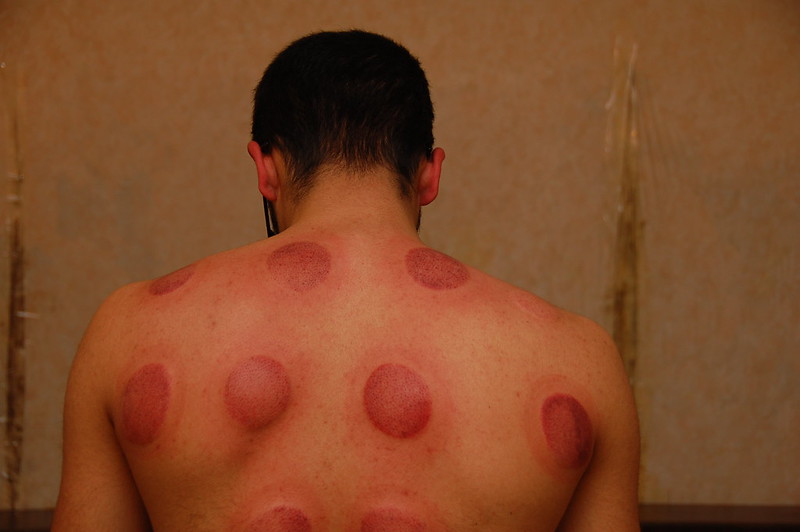 Cupping marks