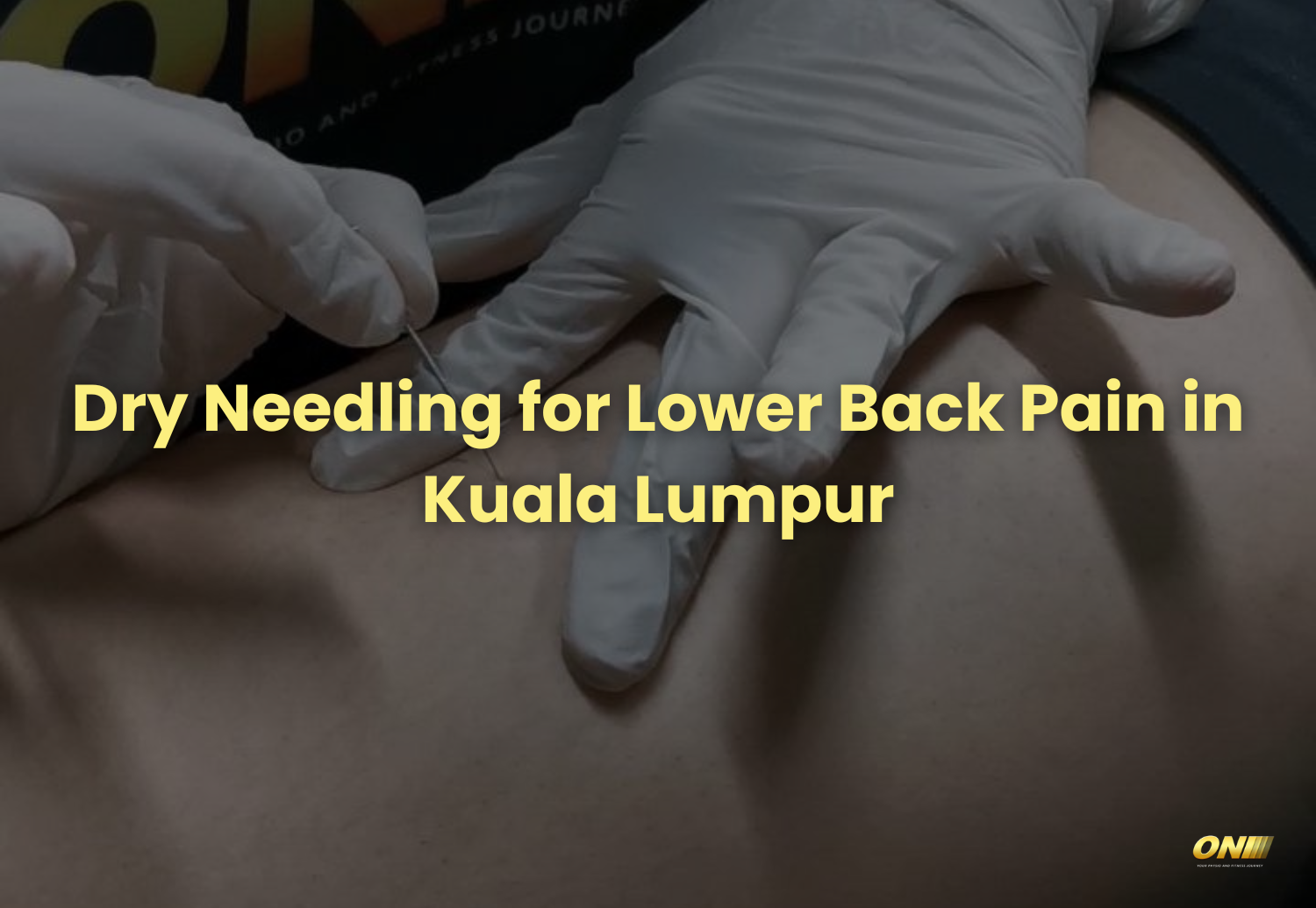 Dry Needling for Lower back pain in Kuala Lumpur