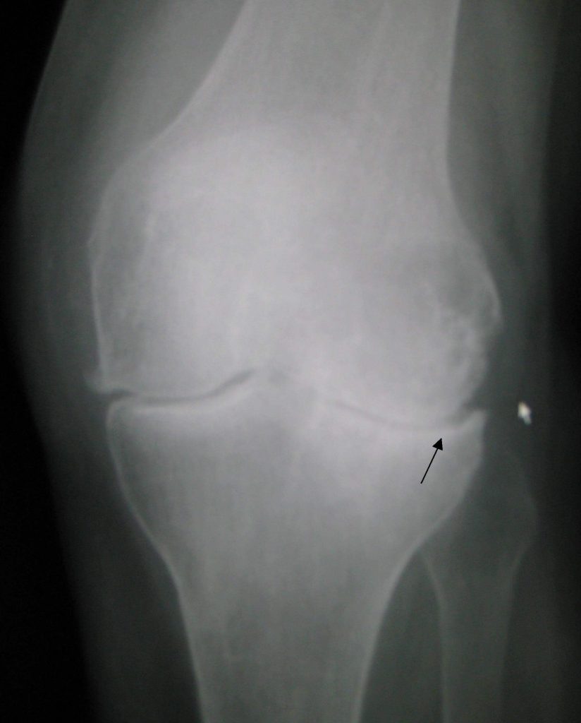 How to treat Knee Osteoarthritis