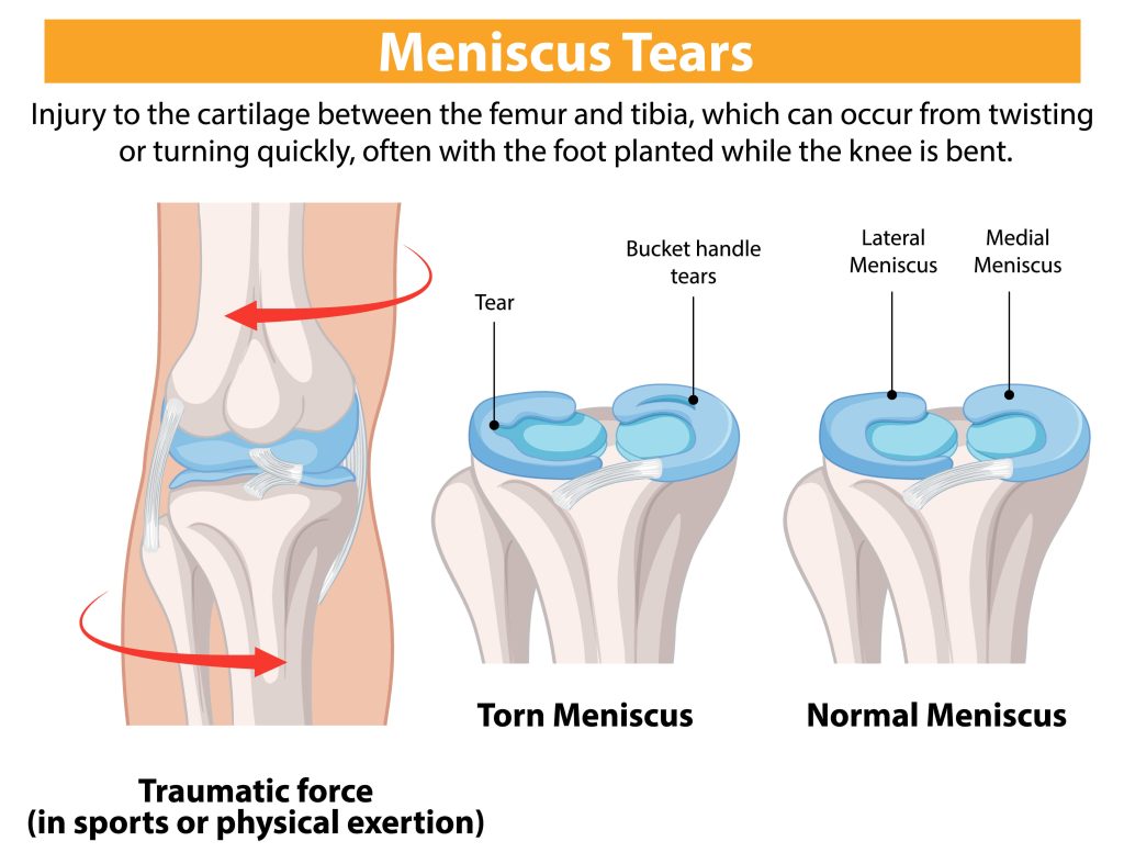 Knee pain after running: Meniscus tear