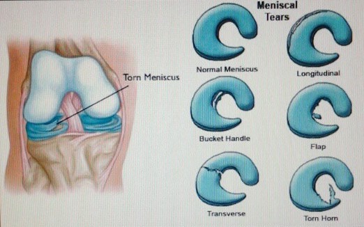 Meniscus Tear ONI Physio Fitness Treatment KL