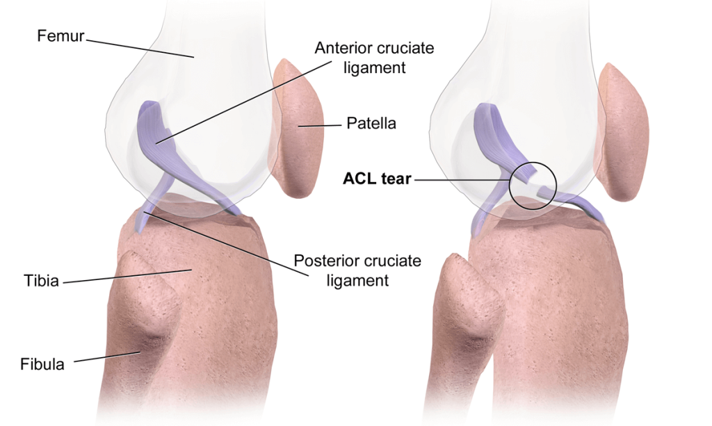 What to Do After an ACL Tear: Causes, Symptoms, Treatment & Prevention in Kuala Lumpur