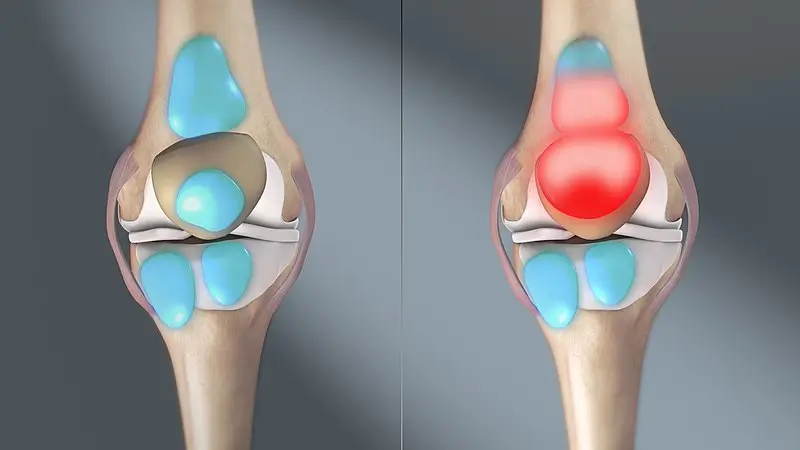 knee bursitis physiotherapy treatment Mont Kiara Kuala Lumpur