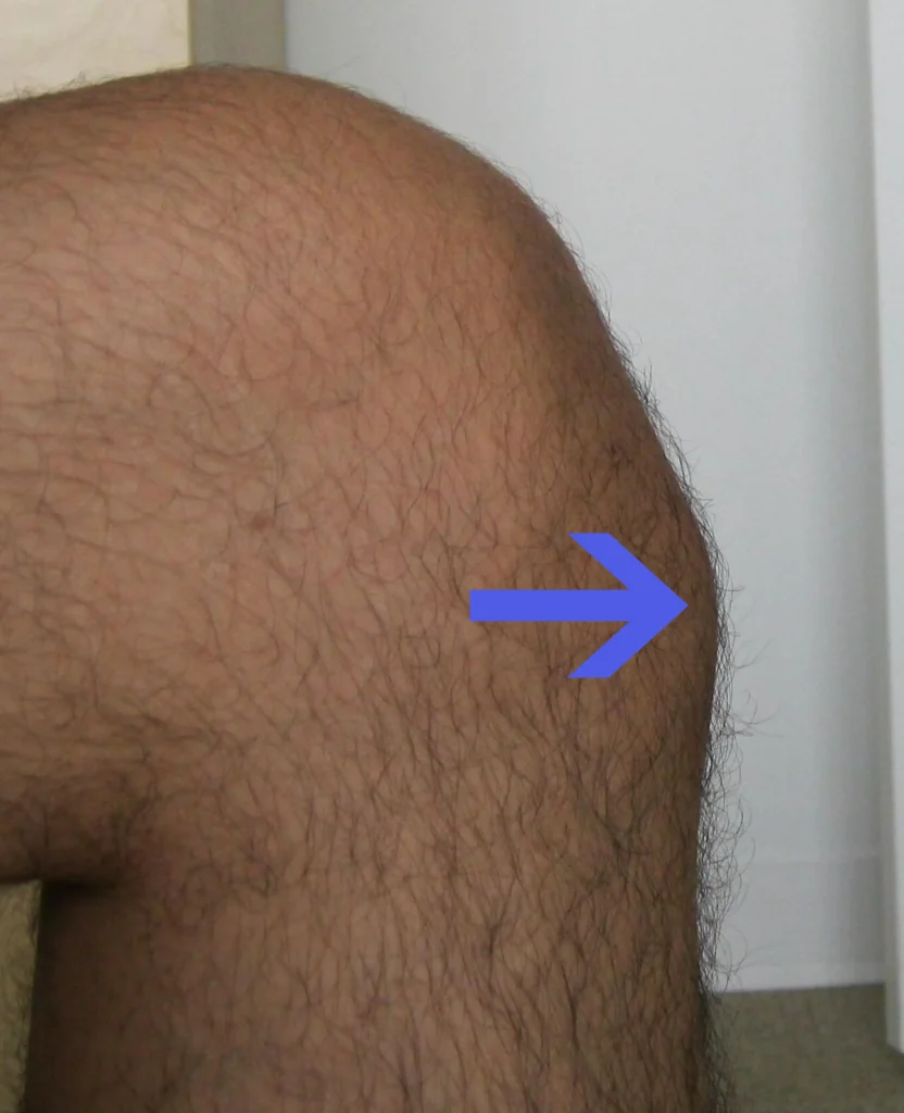 osgood-schlatter disease knee