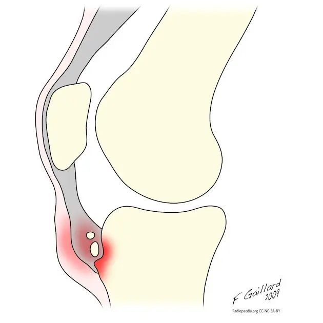 osgood-schlatter disease knee pain