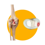 ACL and meniscus injury Physiotherapy Mont Kiara ACL and meniscus injury Physiotherapy Mont Kiara