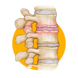 Back arthritis Back arthritis