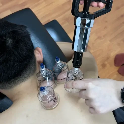 Neck cupping therapy Neck cupping therapy