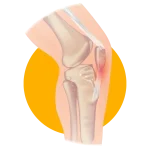 Patellar tendinitis (jumper’s knee) Physiotherapy Mont Kiara Patellar tendinitis (jumper's knee) Physiotherapy Mont Kiara