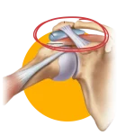 Shoulder bursitis physiotherapy Mont Kiara Shoulder bursitis physiotherapy Mont Kiara