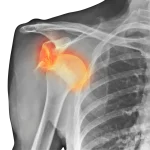 Shoulder dislocation and instability physiotherapy Mont Kiara Shoulder dislocation and instability physiotherapy Mont Kiara