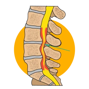 Spinal stenosis Spinal stenosis