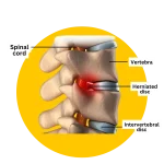 herniated disc