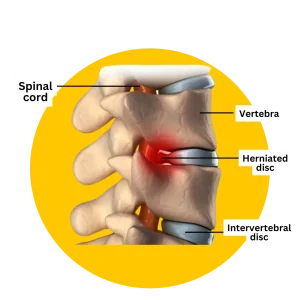 herniated disc (1) herniated disc