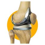 total knee replacement surgery rehab Physiotherapy Mont Kiara total knee replacement surgery rehab Physiotherapy Mont Kiara